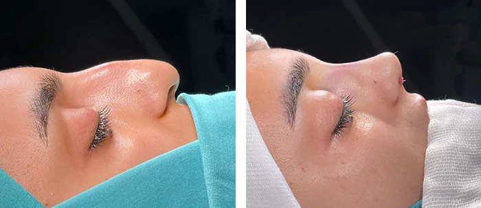 Before and after facial surgery — case 4