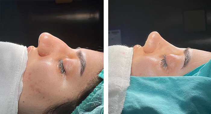 Before and after facial surgery — case 5
