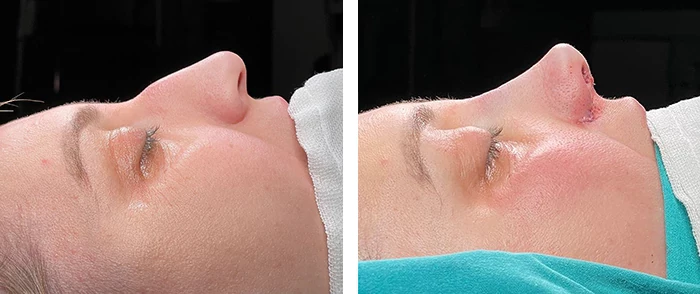 Before and after facial surgery — case 6