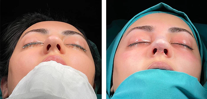 Before and after facial surgery — case 7