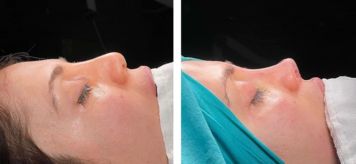 Revision rhinoplasty before and after — case 8