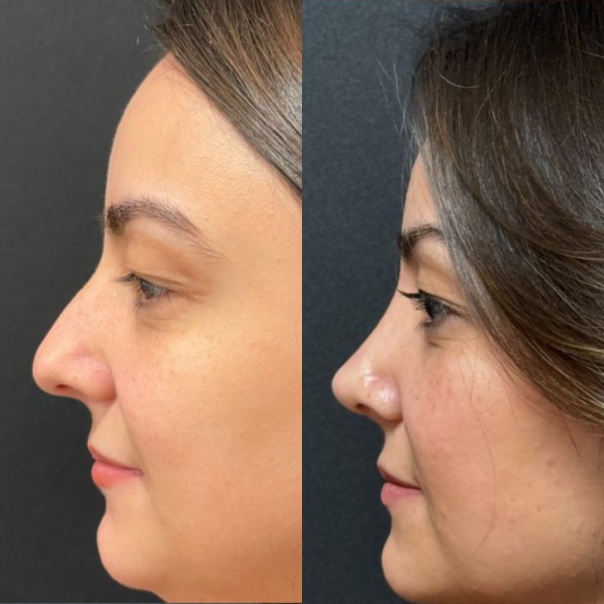 Rhinoplasty before and after — case 1