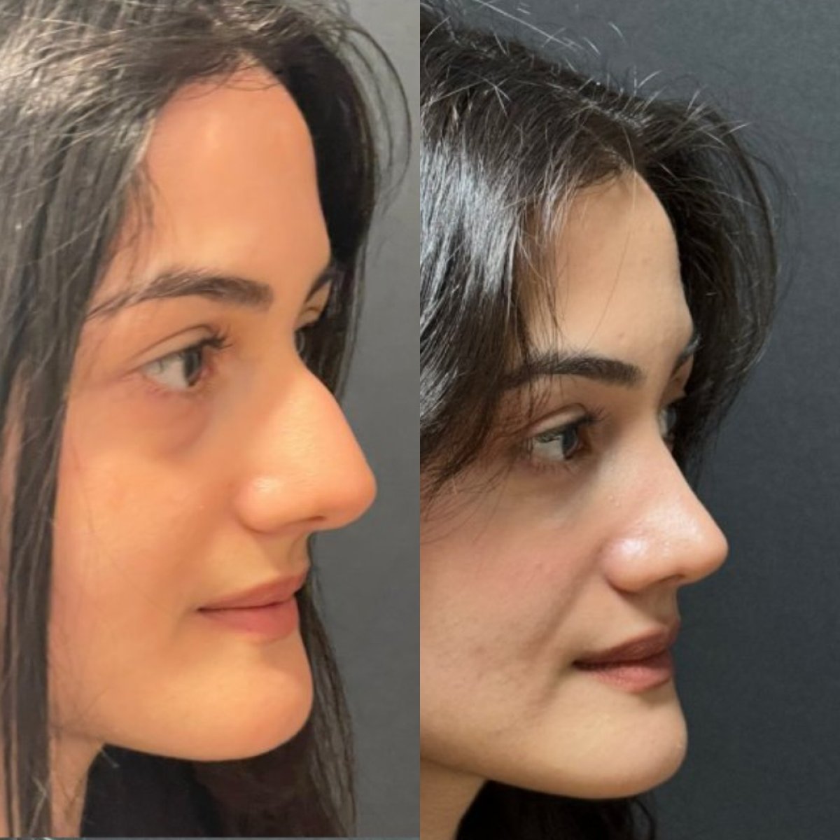 Rhinoplasty before and after — case 2