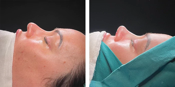 Rhinoplasty before and after — case 3
