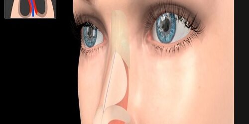 Burun Ameliyat Sonrası Kaç Gece Hastanede Yatacağım | Burun ameliyatından sonra hastanede kalma süresi, ameliyatın karmaşıklığına ve hastanın durumuna bağlı olarak değişebilir.