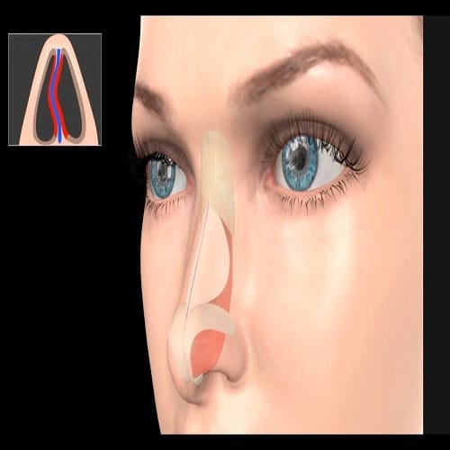 Burun Ameliyat Sonrası Kaç Gece Hastanede Yatacağım | Burun ameliyatından sonra hastanede kalma süresi, ameliyatın karmaşıklığına ve hastanın durumuna bağlı olarak değişebilir.