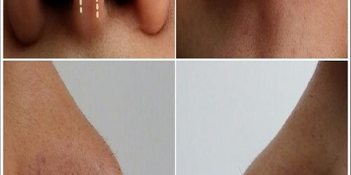 Burun Ameliyatı Sonrası İşe Dönme Süresi