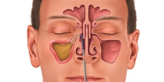 Endoskopik Sinüs Cerrahisi