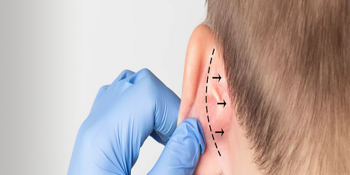 Otoplasti Kaç Günde İyileşir