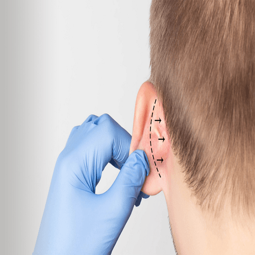 Otoplasti Kaç Günde İyileşir