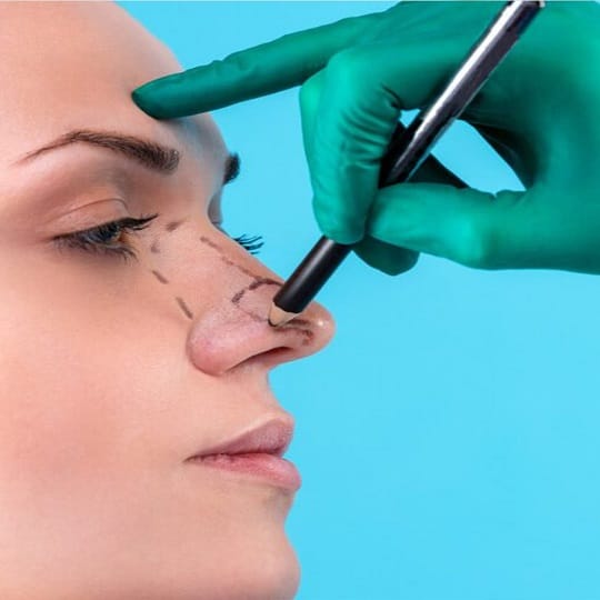 Piezo burun estetiği ne kadar sürede iyileşir