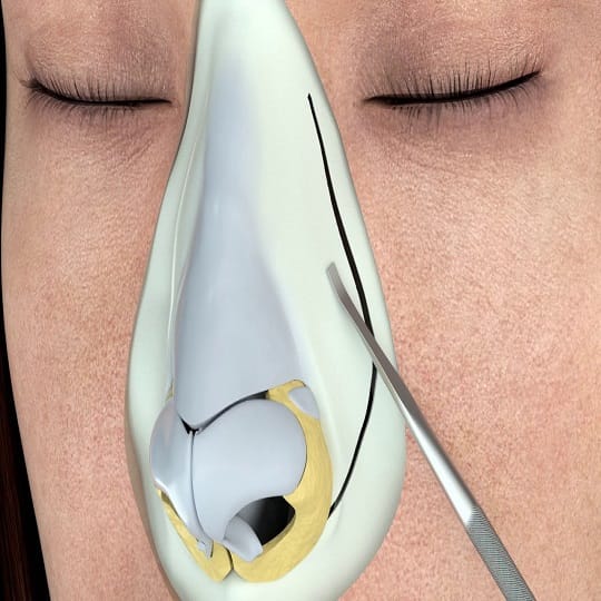 Piezo Burun Estetiği Zor mu