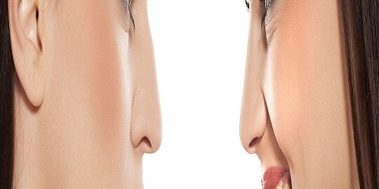 Revizyon Burun Ameliyatı Zor Mu