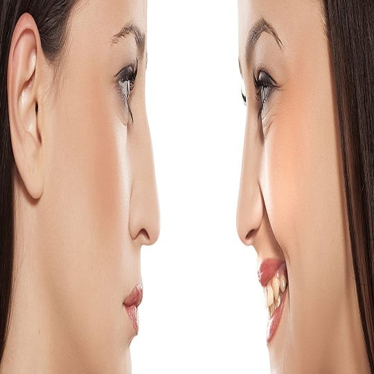 Revizyon Burun Ameliyatı Zor Mu