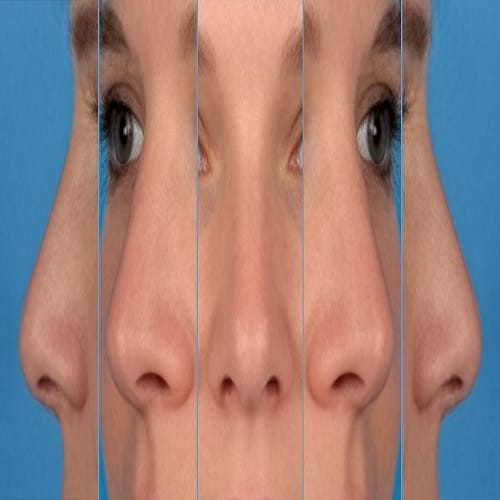 Burun Kaç Ayda Tam Şeklini Alır