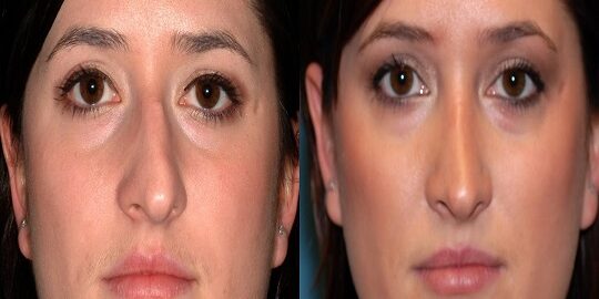 Septoplasti Ameliyatı Riskli Mi