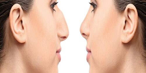 Türkiye'de Ultrasonik Burun Estetiği