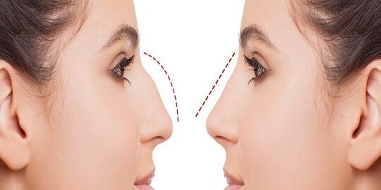 Barbie Burun Estetiği Nedir?