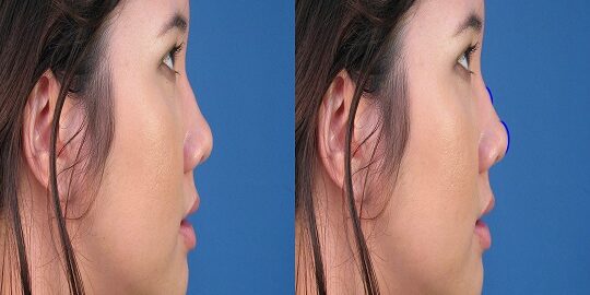 Barbie Nose İstanbul