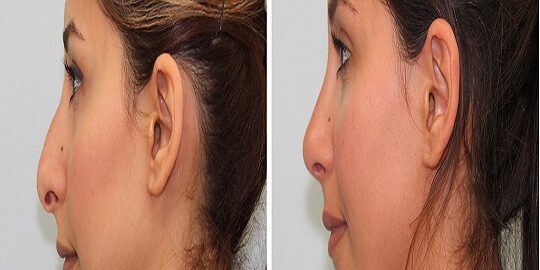 Barbie Burun Estetiği İstanbul