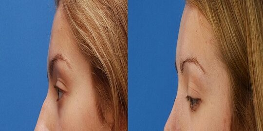 Burun Estetiği Kimlere Yapılmaz?