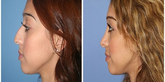 İstanbul'da Etnik Burun Estetiği