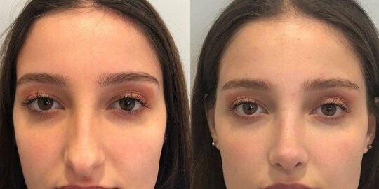 İstanbul'da Burun Estetiği