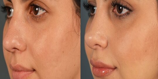 Türkiye ve İstanbul'da Revizyon Burun Estetiği