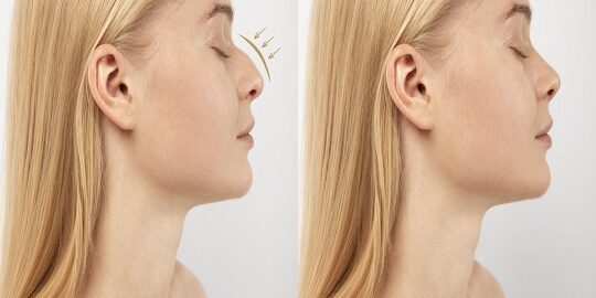 Rinoplasti Kalıcı mı?