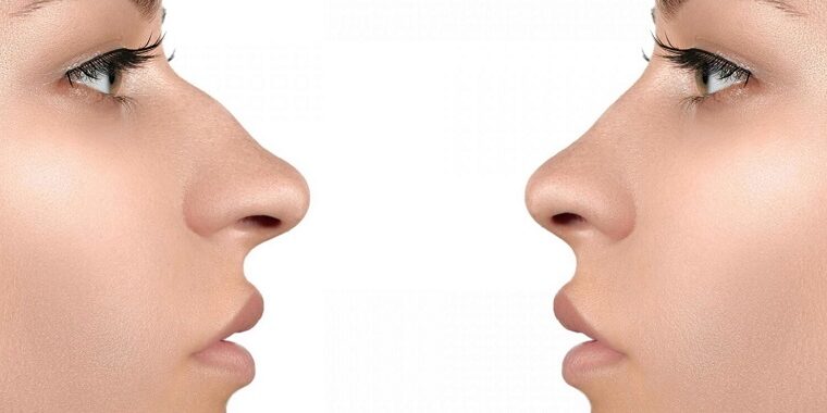 Barbie Nose Rhinoplasty Barbie Nose Rhinoplasty