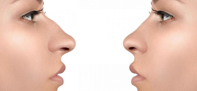 Rinoplastia de nariz de Barbie