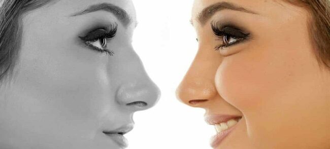 Rhinoplasty