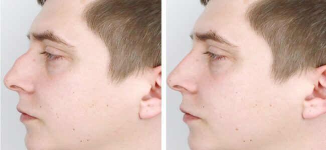 Male Rhinoplasty
