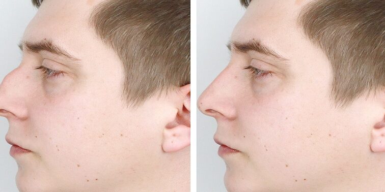 Rinoplastia Masculina