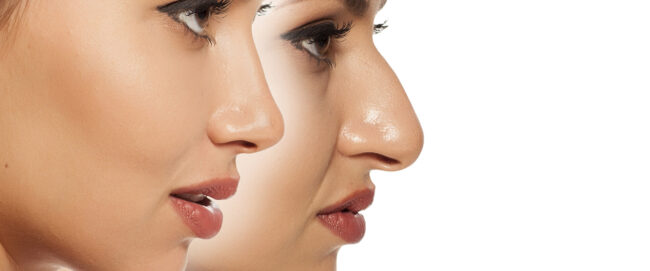 Precision Rhinoplasty