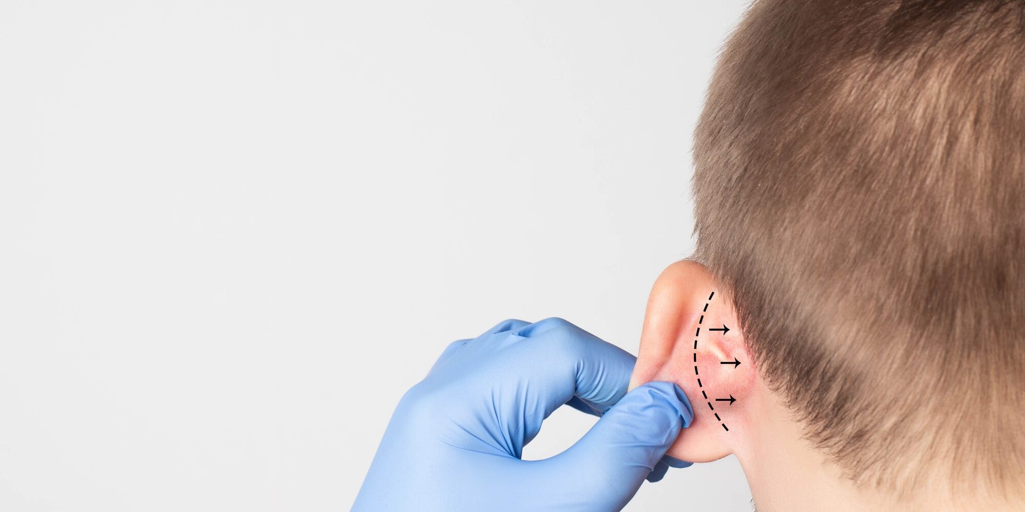 Protruding Ear Surgery