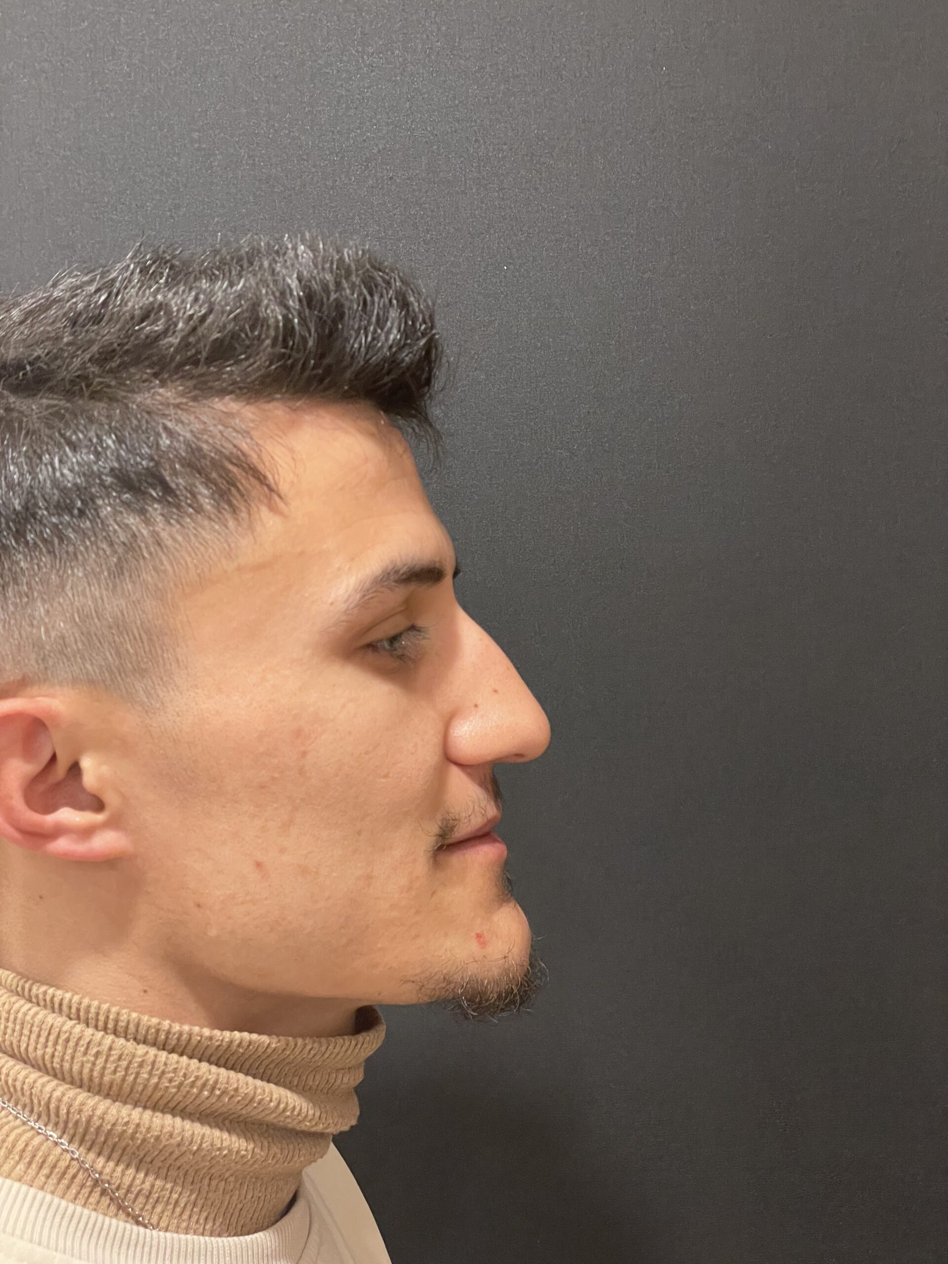 Before Rhinoplasty 3