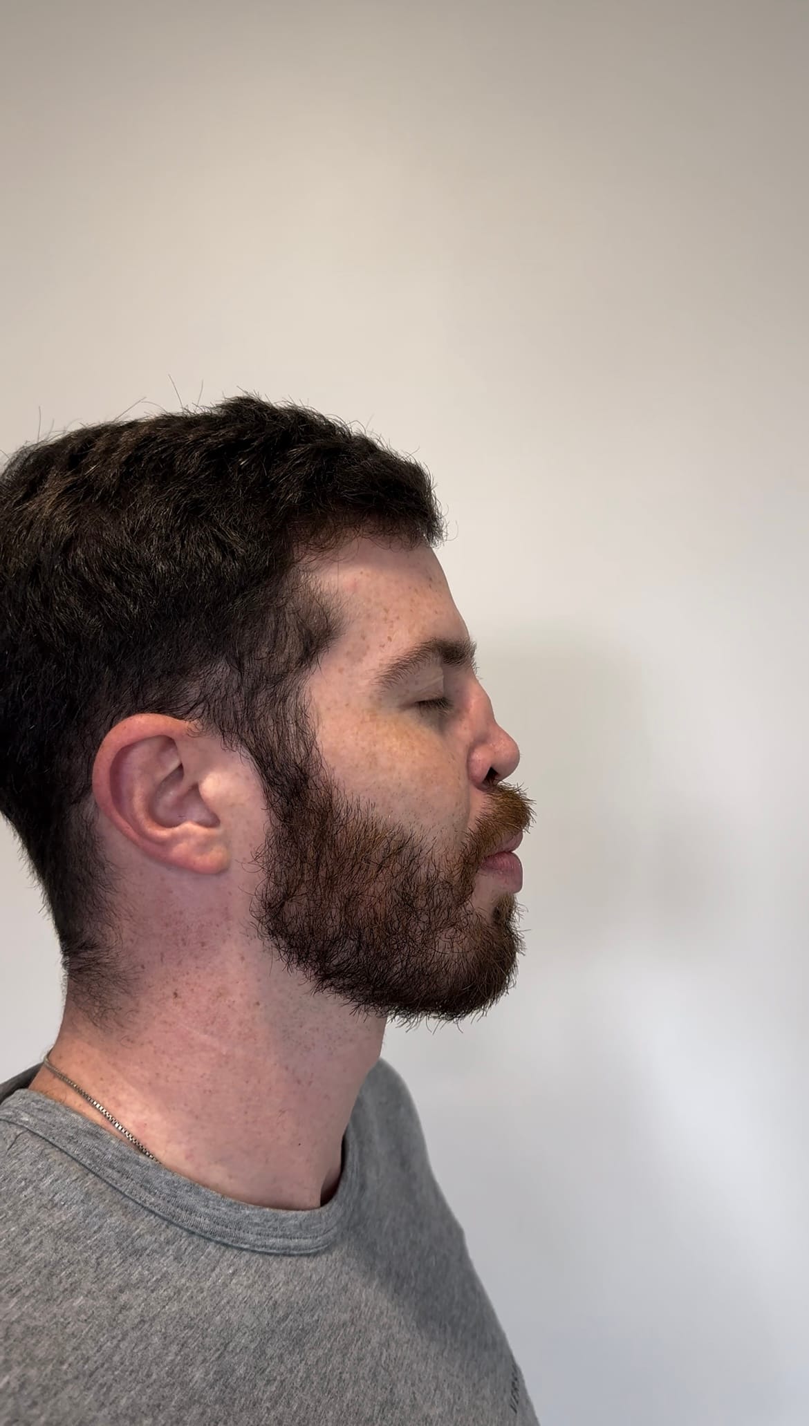 Before Rhinoplasty 4